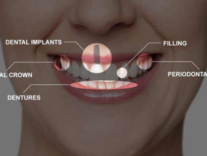 Full Mouth Rehabilitation